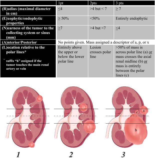 The R E N A L Nephrometry Score Evidencio The R E N A L Nephrometry Score Evidencio
